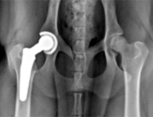 This is the appearance of a total hip replacement in a dog.