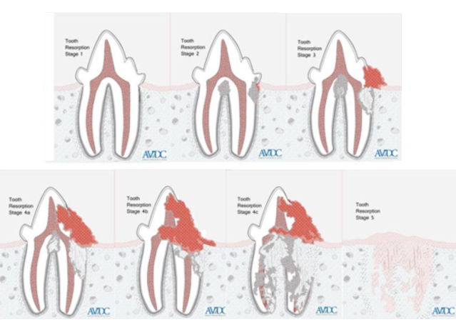 Resorption Stages